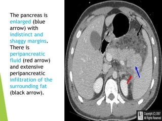 The pancreas is
enlarged (blue
arrow) with
indistinct and
shaggy margins.
There is
peripancreatic
fluid (red arrow)
and extensive
peripancreatic
infiltration of the
surrounding fat
(black arrow).
 