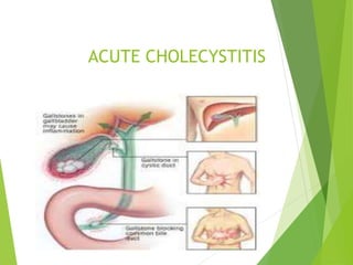 ACUTE CHOLECYSTITIS
 