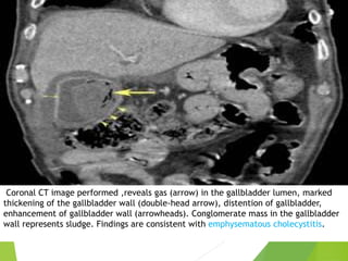 Coronal CT image performed ,reveals gas (arrow) in the gallbladder lumen, marked
thickening of the gallbladder wall (double-head arrow), distention of gallbladder,
enhancement of gallbladder wall (arrowheads). Conglomerate mass in the gallbladder
wall represents sludge. Findings are consistent with emphysematous cholecystitis.
 