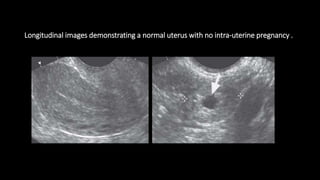 Longitudinal images demonstrating a normal uterus with no intra-uterine pregnancy .
 