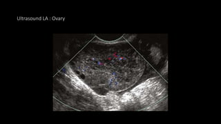 Ultrasound LA : Ovary
 