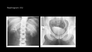 Nephrogram: IVU
 