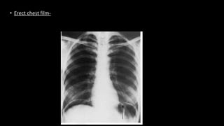 • Erect chest film-
 