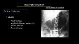 Gastric dilatation
Causes
• Paralytic ileus
• Mechanical bowel obstruction
• Gastric volvulus
• Air swallowing
X-ray abdomen-supine
Intestinal obstruction
 