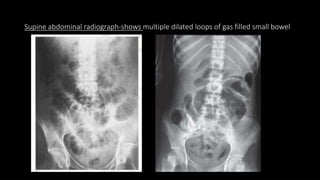 Supine abdominal radiograph-shows multiple dilated loops of gas filled small bowel
 