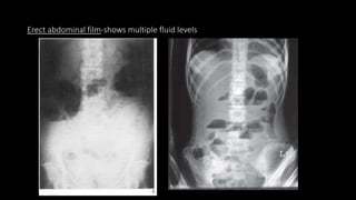 Erect abdominal film-shows multiple fluid levels
 