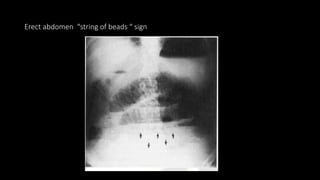 Erect abdomen “string of beads “ sign
 