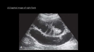 US Sagittal image of right flank
 