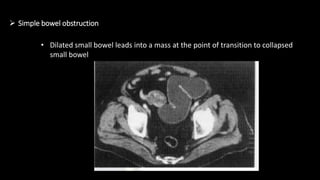  Simple bowel obstruction
• Dilated small bowel leads into a mass at the point of transition to collapsed
small bowel
 