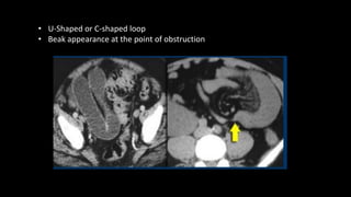 • U-Shaped or C-shaped loop
• Beak appearance at the point of obstruction
 