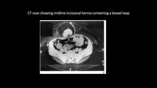 CT scan showing midline incisional hernia containing a bowel loop
 