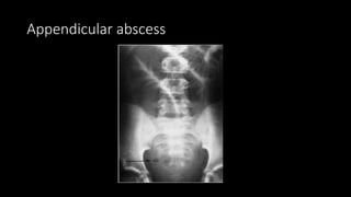 Appendicular abscess
 
