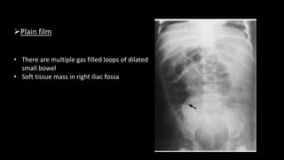 Plain film
• There are multiple gas filled loops of dilated
small bowel
• Soft tissue mass in right iliac fossa
 