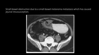 Small-bowel obstruction due to a small-bowel melanoma metastasis which has caused
jejunal intussusception.
 