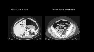Gas in portal vein Pneumatosis intestinalis
 