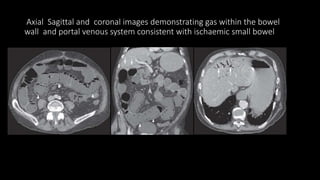 Axial Sagittal and coronal images demonstrating gas within the bowel
wall and portal venous system consistent with ischaemic small bowel
 