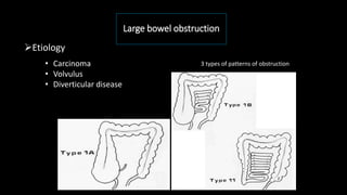 Large bowel obstruction
Etiology
• Carcinoma
• Volvulus
• Diverticular disease
3 types of patterns of obstruction
 