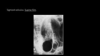 Sigmoid volvulus. Supine film.
 