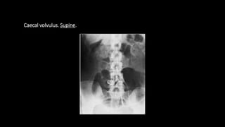 Caecal volvulus. Supine.
 