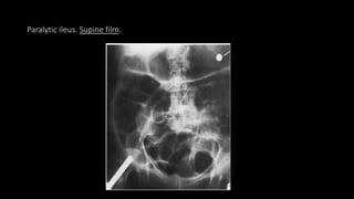 Paralytic ileus. Supine film.
 