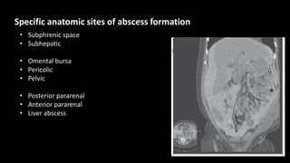 • Subphrenic space
• Subhepatic
• Omental bursa
• Pericolic
• Pelvic
• Posterior pararenal
• Anterior pararenal
• Liver abscess
Specific anatomic sites of abscess formation
 