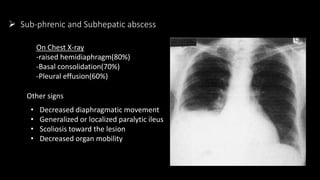  Sub-phrenic and Subhepatic abscess
On Chest X-ray
-raised hemidiaphragm(80%)
-Basal consolidation(70%)
-Pleural effusion(60%)
Other signs
• Decreased diaphragmatic movement
• Generalized or localized paralytic ileus
• Scoliosis toward the lesion
• Decreased organ mobility
 