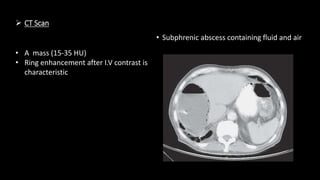  CT Scan
• Subphrenic abscess containing fluid and air
• A mass (15-35 HU)
• Ring enhancement after I.V contrast is
characteristic
 