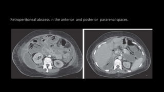 Retroperitoneal abscess in the anterior and posterior pararenal spaces.
 