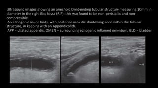 Ultrasound images showing an anechoic blind-ending tubular structure measuring 10mm in
diameter in the right iliac fossa (RIF): this was found to be non-peristaltic and non-
compressible.
An echogenic round body, with posterior acoustic shadowing seen within the tubular
structure, in keeping with an Appendicolith.
APP = dilated appendix, OMEN = surrounding echogenic inflamed omentum, BLD = bladder
 
