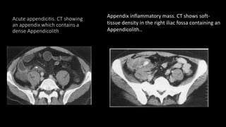 Acute appendicitis. CT showing
an appendix which contains a
dense Appendicolith
Appendix inflammatory mass. CT shows soft-
tissue density in the right iliac fossa containing an
Appendicolith..
 