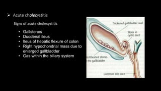  Acute cholecystitis
• Gallstones
• Duodenal ileus
• Ileus of hepatic flexure of colon
• Right hypochondrial mass due to
enlarged gallbladder
• Gas within the biliary system
Signs of acute cholecystitis
 