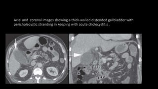 Axial and coronal images showing a thick-walled distended gallbladder with
pericholecystic stranding in keeping with acute cholecystitis .
 