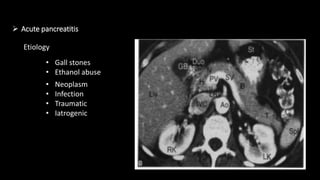  Acute pancreatitis
Etiology
• Gall stones
• Ethanol abuse
• Neoplasm
• Infection
• Traumatic
• Iatrogenic
 