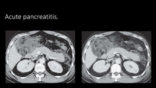 Acute pancreatitis.
 