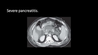 Severe pancreatitis.
 