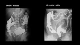Chron’s disease Ulcerative colitis
 