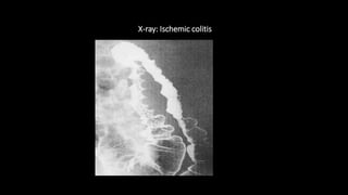 X-ray: Ischemic colitis
 