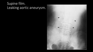 Supine film.
Leaking aortic aneurysm.
 