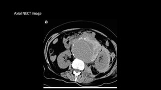 Axial NECT image
 