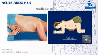 Normal Puddle Sign Acute abdomen | PDF
