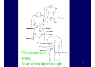 16
Characteristic
scars,
Now often laparoscopy
 