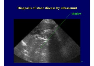Diagnosis of stone disease by ultrasound
shadow
27
 