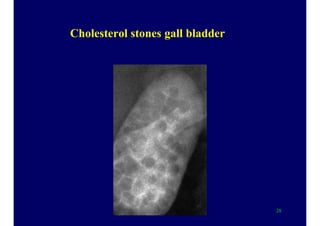 Cholesterol stones gall bladder
28
 