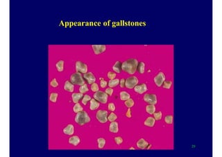 Appearance of gallstones
29
 