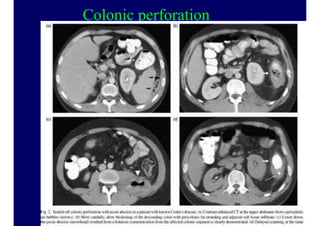 Colonic perforation
50
 
