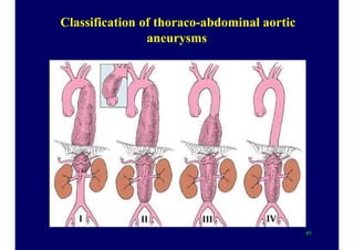 Classification of thoraco-abdominal aortic
aneurysms
49
 