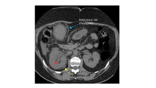 Pyelo Fat Stranding Acute abdomen | PPTX