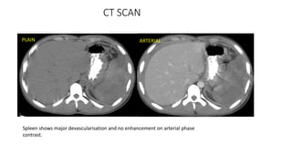 Devascularization Ct Acute abdomen | PPTX