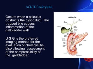 ACUTE Cholecystitis
Occurs when a calculus
obstructs the cystic duct. The
trapped bile causes
inflammation of the
gallbladder wall.
U S G is the preferred
imaging method for the
evaluation of cholecystitis,
also allowing assessment
of the compressibility of
the gallbladder.
 