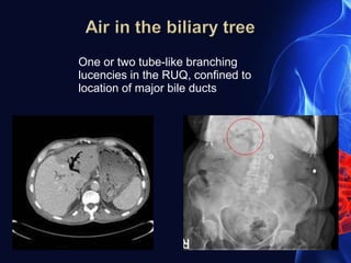 One or two tube-like branching
lucencies in the RUQ, confined to
location of major bile ducts
 
